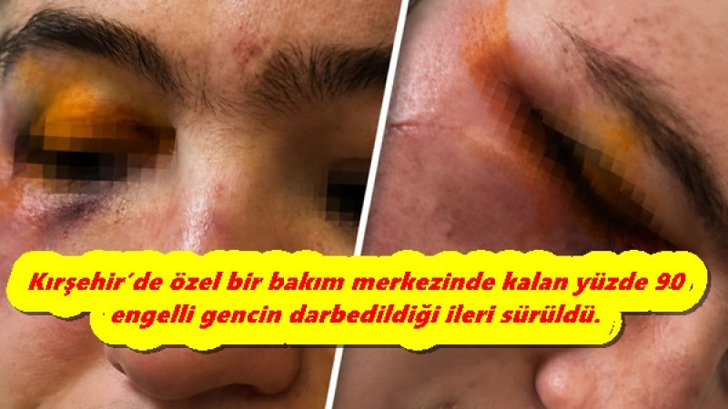 Kırşehir’de özel bir bakım merkezinde kalan yüzde 90 engelli gencin darbedildiği ileri sürüldü.